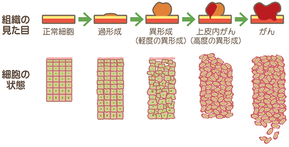 上皮がんのステージ